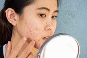 Portrait of Asian woman worry about her face when she saw the problem of acne inflammation and scar by the mini mirror.